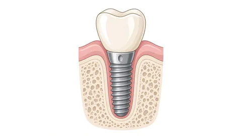 Clinical cross-section illustration of a dental implant in the jawbone with a titanium post, abutment and porcelain crown