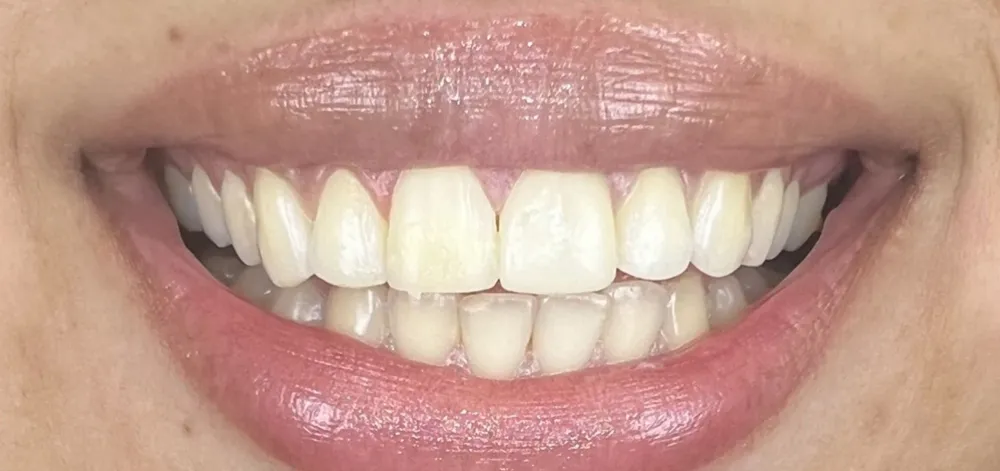 Before-and-after dental treatment photo 2
