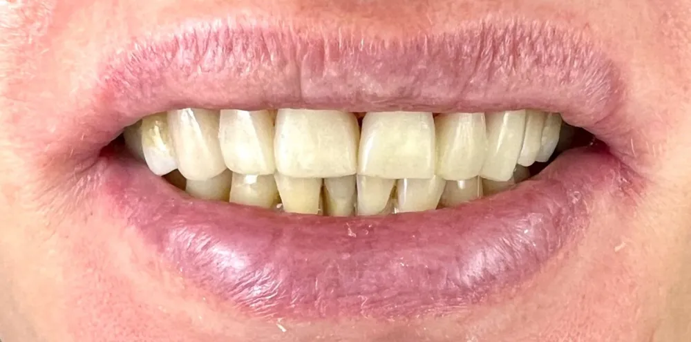 Before-and-after dental treatment photo 4