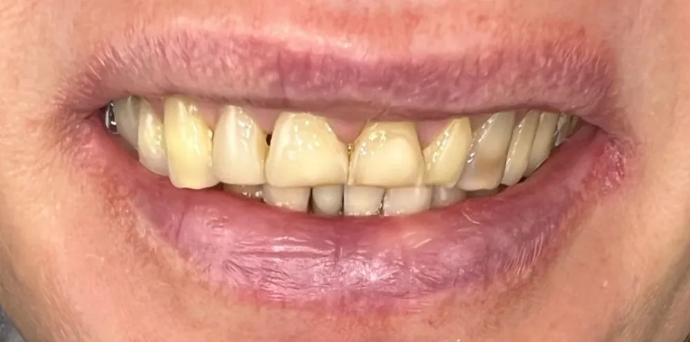 Before-and-after dental treatment photo 3