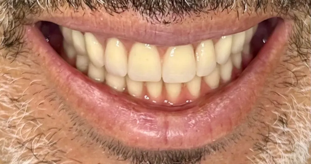 Before-and-after dental treatment photo 6